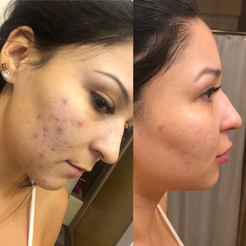 Emil A Tanghetti, MD - Before treatment and After pic! Acne has cleared up so much with antibiotics and topical creams. PA Mike is great! - Dermatologists Near Me - Sacramento, California