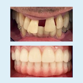 JC Dental Care - As a cosmetic dentist, Dr. Camacho specializes in All-On-Four Implants, a full smile corrective treatment that helps patients... - Cosmetic Dentists Near Me - Houston, Texas JC Dental Care - As a cosmetic dentist, Dr. Camacho specializes in All-On-Four Implants, a full smile corrective treatment that helps patients... - Cosmetic Dentists Near Me - Houston, Texas