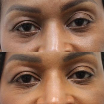 Melanie Tantisira M.D - Tear Trough Filler. Our doctor conceals dark circles under the eyes with filler safely placed directly into the hollow with a cannula. - Ophthalmologists Near Me - Honolulu, Hawaii