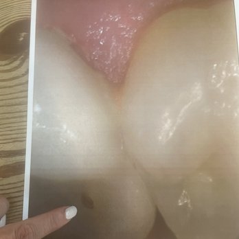 Appealing Dentistry - Hole in the bottom of my crown for her over filing - General Dentistry Near Me - Rancho Santa Margarita, California Appealing Dentistry - Hole in the bottom of my crown for her over filing - General Dentistry Near Me - Rancho Santa Margarita, California