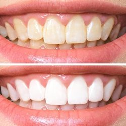 A 1 Dental - Limpieza de dientes