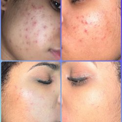 Tesoro Laser Spa - Effective acne treatments