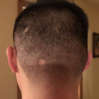 Floyd's 99 Barbershop - Bad hair cut really messed it up with a bald spot:( - Barbers Near Me - Annapolis, Maryland Floyd's 99 Barbershop - Bad hair cut really messed it up with a bald spot:( - Barbers Near Me - Annapolis, Maryland