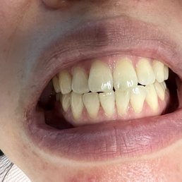 My yellowish teeth Before whitening My yellowish teeth Before whitening