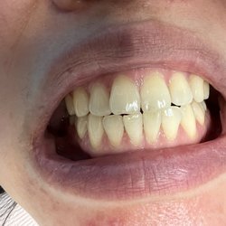 Kind Kare Dental - My yellowish teeth Before whitening