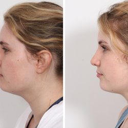 Benjamin Paul MD - Revision Rhinoplasty By Dr. Benjamin Paul