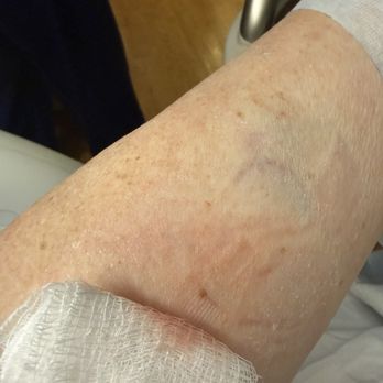 Northside Hospital Forsyth - Left arm. IV failure. Multiple blood draws - Hospitals Near Me - Cumming, Georgia Northside Hospital Forsyth - Left arm. IV failure. Multiple blood draws - Hospitals Near Me - Cumming, Georgia