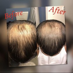 Organic Facial Experience Medical Day Spa - Before and After use of Essential Healing Stimulating Hair Growth Oil. 3 weeks