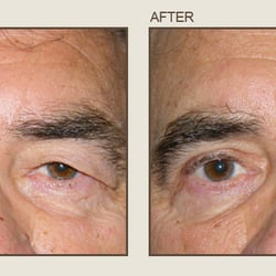 Center For Eye & Laser Surgery - Before & After
Center for Eye & Laser Surgery- Severna Park, Maryland