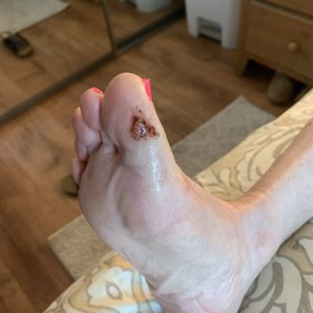 Classy Nails - Mom foot after nail tech scrape the skin off - Nail Salons Near Me - Daly City, California