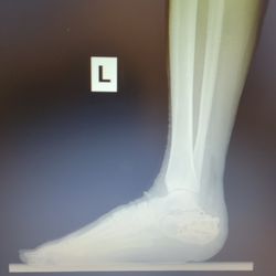 Garnet & Carbonell, DPM - This is a repair of my left foot with titanium screws and locks. There was also a plate placed.