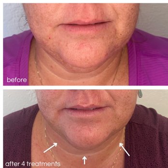 Empress Wellness - Acupuncture Facial can help contour face, improve muscle tone, and improve skin health. - Acupuncture Near Me - Long Beach, California Empress Wellness - Acupuncture Facial can help contour face, improve muscle tone, and improve skin health. - Acupuncture Near Me - Long Beach, California