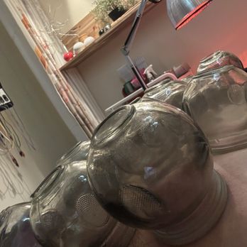 Natural Acupuncture & Cupping Center - Cupping on my back - Traditional Chinese Medicine Near Me - Arcadia, California Natural Acupuncture & Cupping Center - Cupping on my back - Traditional Chinese Medicine Near Me - Arcadia, California
