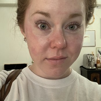 Rawwbeauty - Immediately after the hydrafacial - Tattoo Removal Near Me - Homewood, Alabama