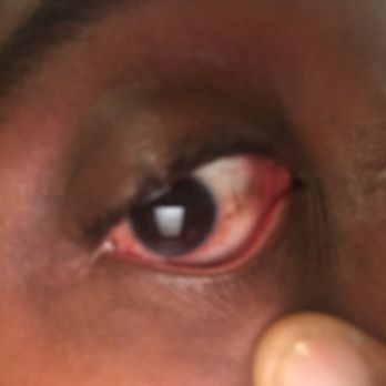 Leroy Vaughn, MD - Stay away from this idiot of an eye doctor Leroy W. Vaughn, MD.......He does not know what he's doing and is a negligent fool.m - Ophthalmologists Near Me - Inglewood, California