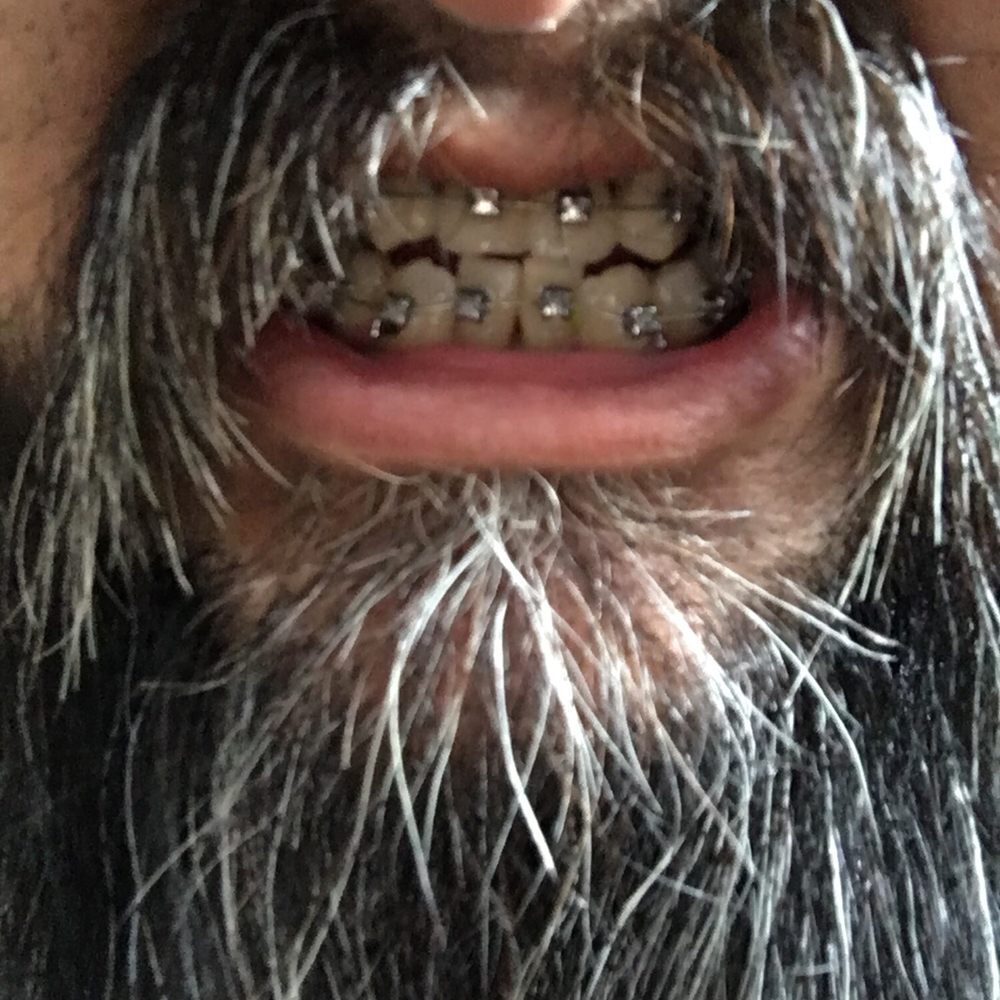 John J Eisinger, DDS - So, I have been checking my teeth everyday and I noticed that just after four days I had already had major movement. I was amazed. Thank You - Orthodontists Near Me - Marina, California John J Eisinger, DDS - So, I have been checking my teeth everyday and I noticed that just after four days I had already had major movement. I was amazed. Thank You - Orthodontists Near Me - Marina, California