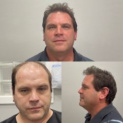 12 months hair transplant
