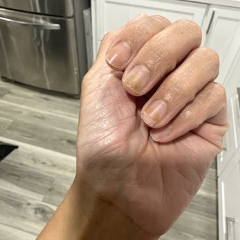 Long Lasting Nails - 2 weeks post anti fungal treatment. - Nail Salons Near Me - Carson, California