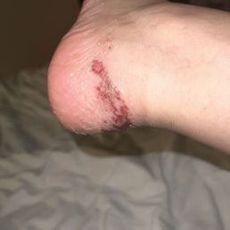 Infected ankle Infected ankle