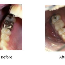 Dr Smile - Resin (tooth colored) Fillings