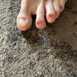 Premier Nail Bar - Toes affected