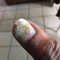 Nail fungus Nail fungus