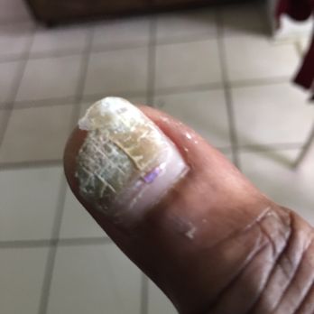 C F Nail Care - Nail fungus - Nail Salons Near Me - Englewood, New Jersey C F Nail Care - Nail fungus - Nail Salons Near Me - Englewood, New Jersey