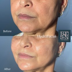 HydraFacial Deluxe incorporates boosters selected to meet your skincare goals + LED light therapy