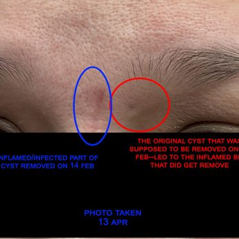 Raj Joyesh, MD - Raj Plastic Surgery - The cyst remains visible 2 months later while the incision has fully healed. Apr 13, 2025 - Plastic Surgeons Near Me - Westlake, Ohio Raj Joyesh, MD - Raj Plastic Surgery - The cyst remains visible 2 months later while the incision has fully healed. Apr 13, 2025 - Plastic Surgeons Near Me - Westlake, Ohio