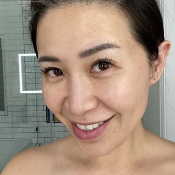 Radiance Med Spa - After ipl (8weeks) and picosure (2 weeks) - Medical Spas Near Me - Pasadena, California Radiance Med Spa - After ipl (8weeks) and picosure (2 weeks) - Medical Spas Near Me - Pasadena, California