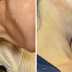 Plastic Surgery Services of Fredericksburg - Before/After