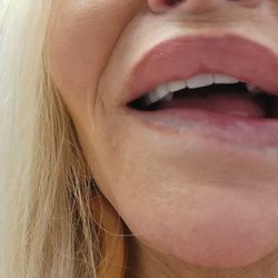 Sean Freeman MD - Damage to prevent in face