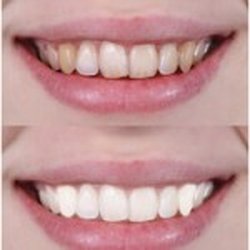 Roycrest Dental Center - TEETH WIHITENING