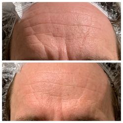 Diamond Glow Facial
Immediate Results