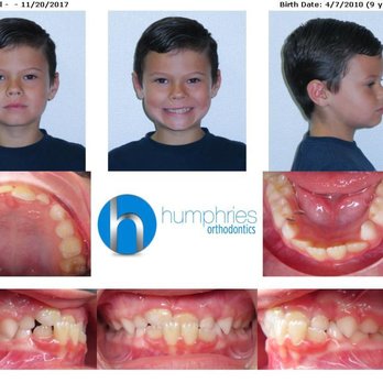 Humphries Orthodontics - This is the "before" picture. Now they are perfect. :) - Orthodontists Near Me - Orange, California