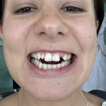Cancún Dental Specialists - This is my before picture - Oral Surgeons Near Me - Cancún, ROO