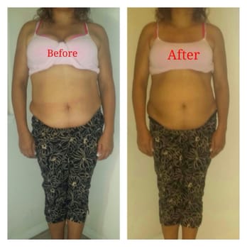 Body Sculpt Wraps - Front view of my Sis after having just one treatment on her abs. No pain, no scars & no downtime required! - Weight Loss Centers Near Me - Los Angeles, California