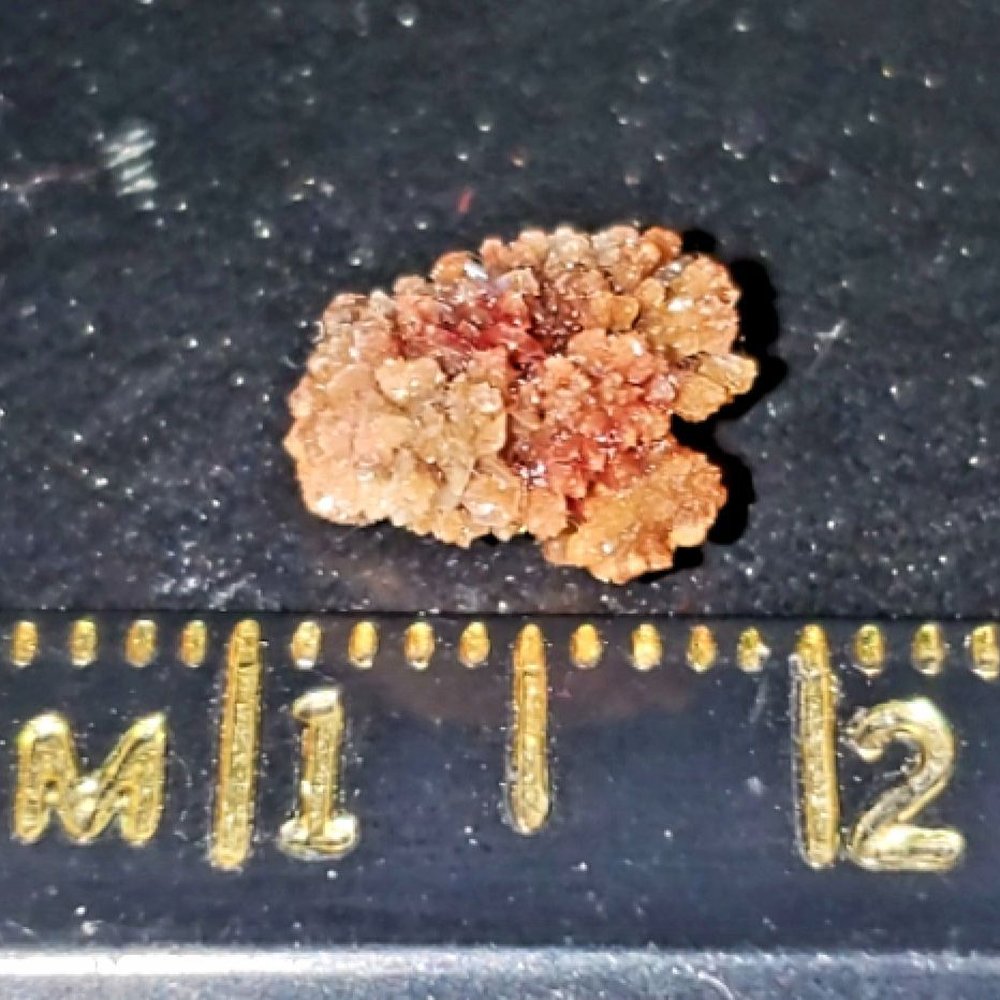 Upstate Community Hospital - 9mm X 7mm kidney stone I passed, two days after ER "physicians couldn't find anything wrong with me. - Hospitals Near Me - Syracuse, New York Upstate Community Hospital - 9mm X 7mm kidney stone I passed, two days after ER "physicians couldn't find anything wrong with me. - Hospitals Near Me - Syracuse, New York