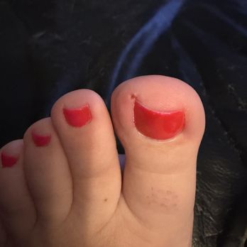 Milford Nail Salon - Missing a chunk out of my big toe. - Nail Salons Near Me - Pleasant Hill, California Milford Nail Salon - Missing a chunk out of my big toe. - Nail Salons Near Me - Pleasant Hill, California