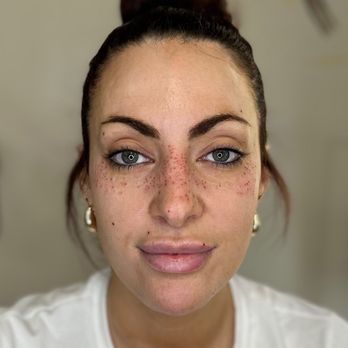 The Micro Clinics - Freckle Tattoo - Permanent Makeup Near Me - Orlando, Florida The Micro Clinics - Freckle Tattoo - Permanent Makeup Near Me - Orlando, Florida
