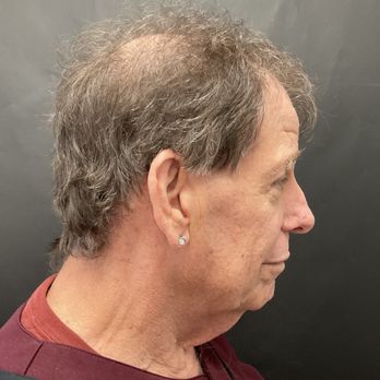 The Ferguson Clinic - Major turkey neck issues and a face that would stop a clock - Cosmetic Surgeons Near Me - Honolulu, Hawaii The Ferguson Clinic - Major turkey neck issues and a face that would stop a clock - Cosmetic Surgeons Near Me - Honolulu, Hawaii