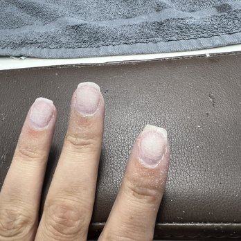 Saigon Nails - Nail split in half after acrylic removal - Nail Salons Near Me - Missoula, Montana Saigon Nails - Nail split in half after acrylic removal - Nail Salons Near Me - Missoula, Montana