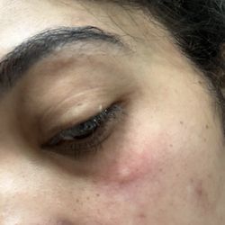 Skin reaction