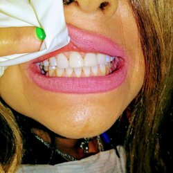 Smiles by Design - After picture, 4 upper crowns done the same day.