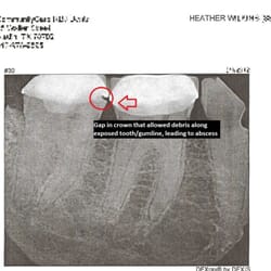 Elite Family Dentistry - This is the tooth referred to in my review, circle is the side portion of the gap between the crown/gums.