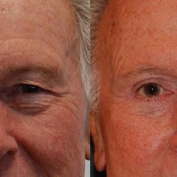Kevin J Cross, MD - Cross Medical Group - Eyelid Surgery