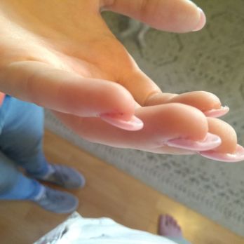 East Town Spa - Cuts like this on all of my fingers. Also note the thickness. - Day Spas Near Me - Milwaukee, Wisconsin East Town Spa - Cuts like this on all of my fingers. Also note the thickness. - Day Spas Near Me - Milwaukee, Wisconsin
