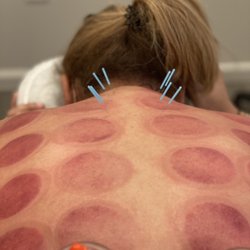 Healthy Mind and Body Acupuncture - Acupuncture and cupping