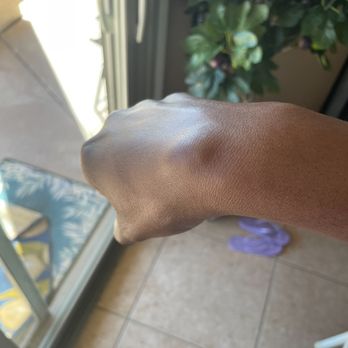 Vital Light Therapy - This before I got light therapy, you can see the huge cyst on my wrist. - Health Coach Near Me Vital Light Therapy - This before I got light therapy, you can see the huge cyst on my wrist. - Health Coach Near Me