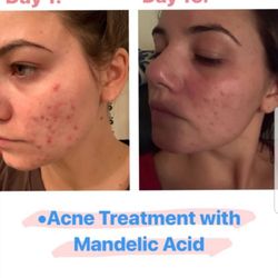 Ana Osorio Beauty Studio - Tratamiento de acné con ácido mandelico.